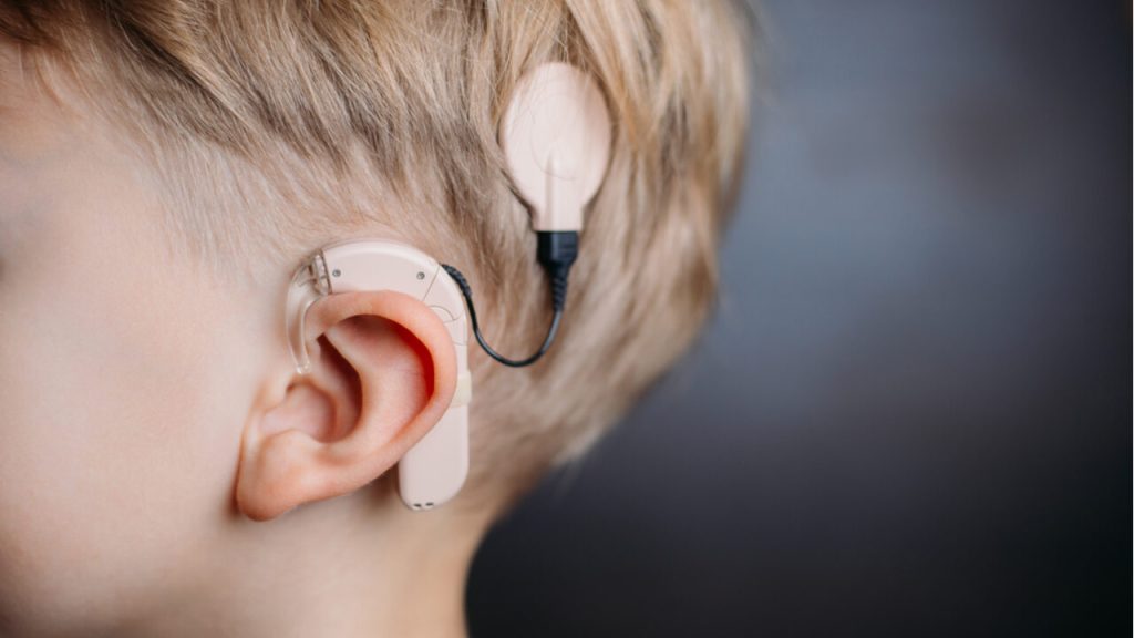 Cochlear implants — with no exterior hardware