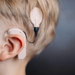 Cochlear implants — with no exterior hardware